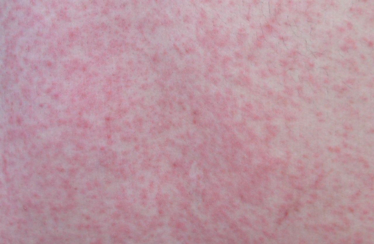 風疹発疹の出方: 大人が風疹にかかると – KGMPYV