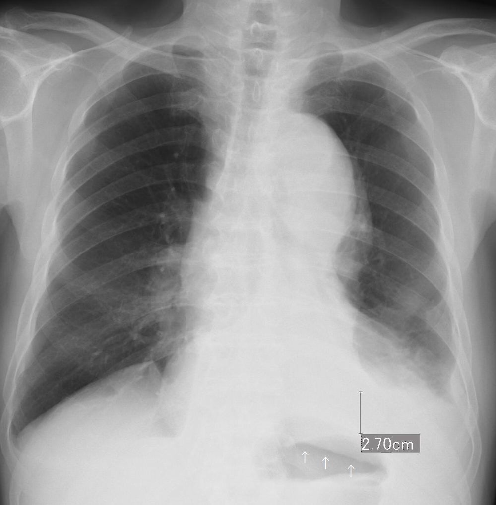 肺炎 胸膜炎 無気肺 こどもの病気 おとなの病気