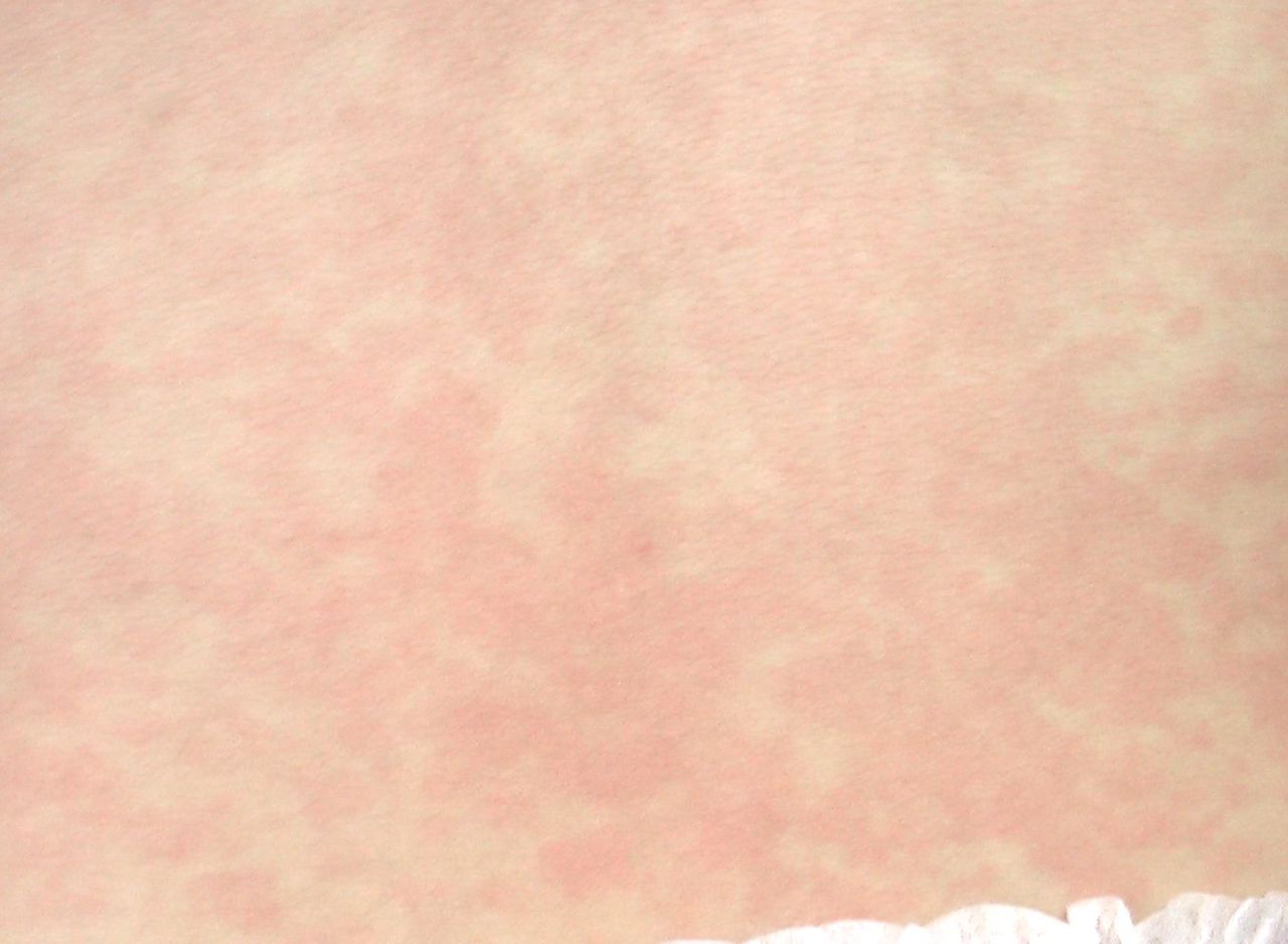 こどもの病気・おとなの病気:突発性発疹(10)(滲出性紅斑様発疹)