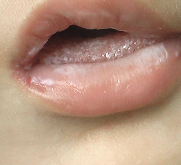 鵞口瘡 こどもの病気 おとなの病気