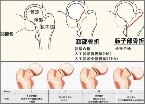 人工股関節