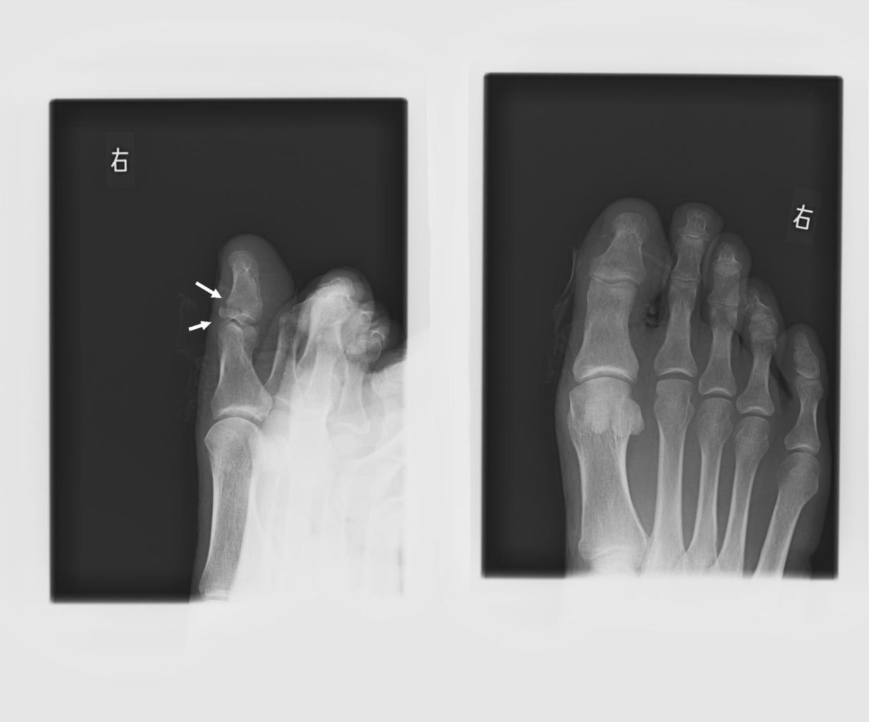 骨折 1 こどもの病気 おとなの病気 骨折 1 こどもの病気 おとなの病気