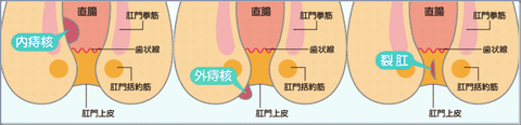 hemotype