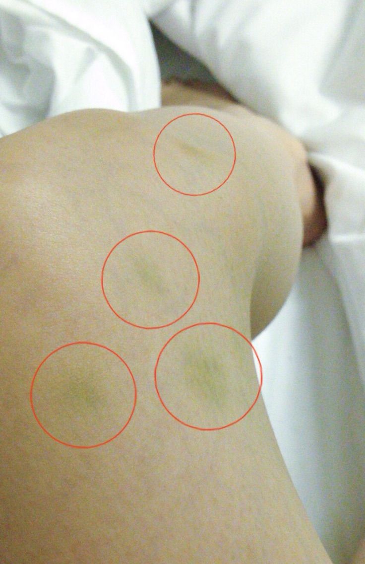 白血病あざ 白血病って必ず青あざや鼻血などの症状がでますか 白血病あざ 白血病って必ず青あざや鼻血などの症状がでますか