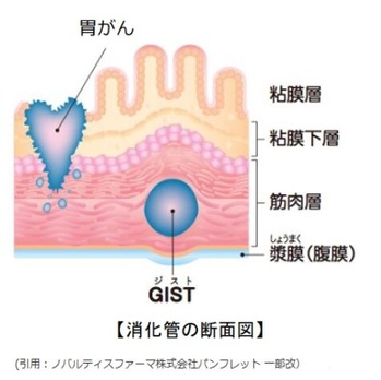 胃GISTの図