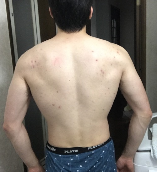 ワイの背中汚いんやが どうしたら綺麗になる まとメメちゃん