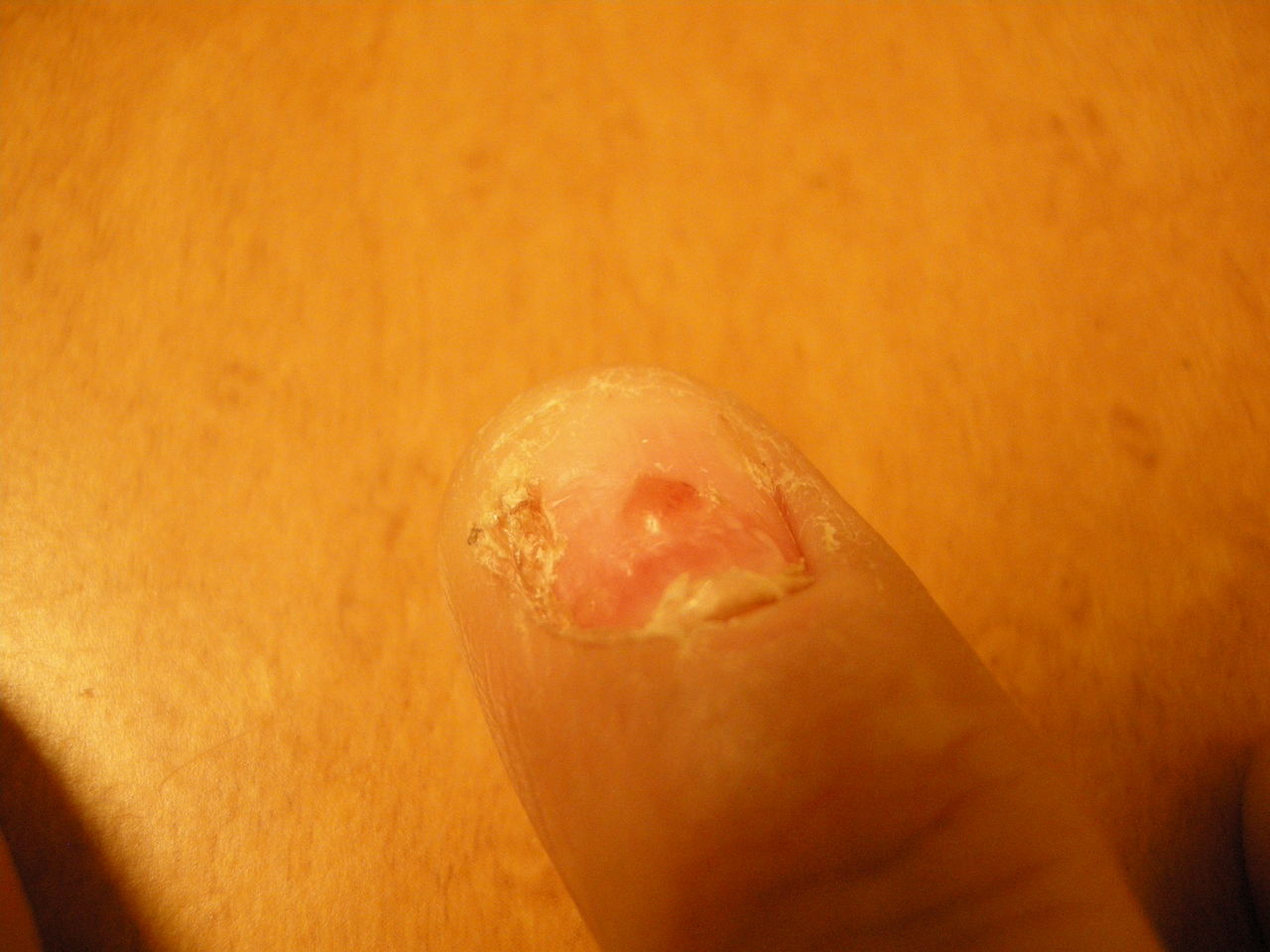 酷い状態の爪 だ地域 日本国 のチョッパリ