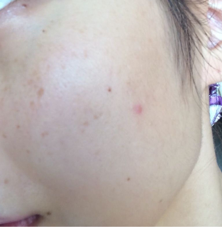 大人ニキビ用の万能化粧水 薬用ピエリナ Happy主婦ブログ