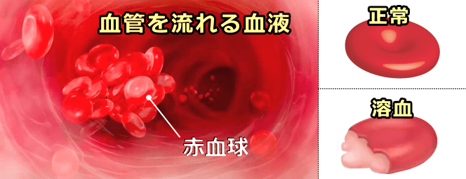 溶血とは原因: 溶血 原因 手技 , 溶血と乳びについて – HGSMQY