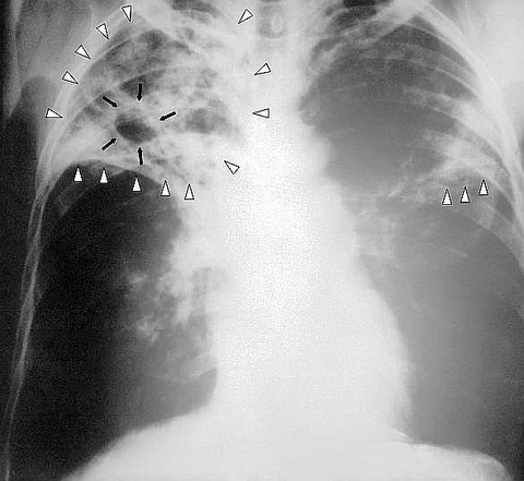 Tuberculosis-x-ray-1