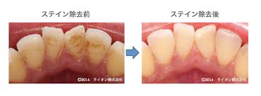 歯の付着物について 堺の歯科医院 ナカノ初芝歯科クリニックのブログ 歯の付着物について 堺の歯科医院 ナカノ初芝歯科クリニックのブログ