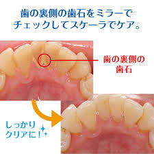 歯の付着物について 堺の歯科医院 ナカノ初芝歯科クリニックのブログ 歯の付着物について 堺の歯科医院 ナカノ初芝歯科クリニックのブログ