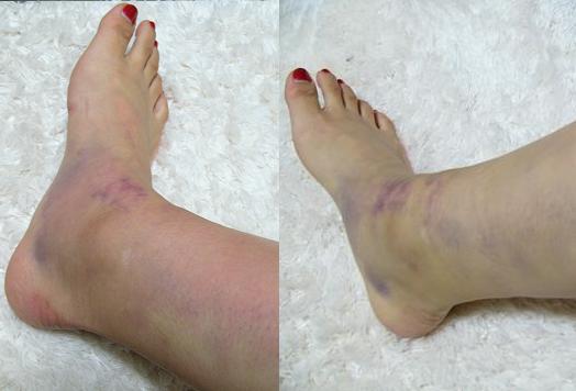 打撲跡のような ネギ風呂 ネギブロ