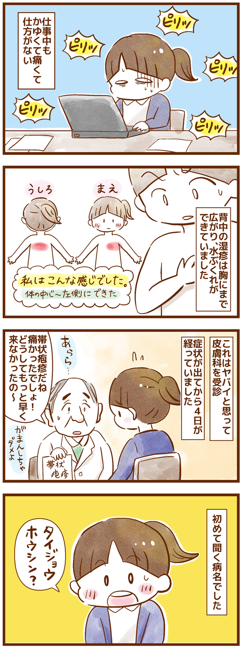 帯状疱疹2