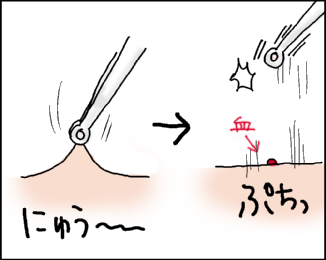 水いぼ治療 処置編 おそらくその平凡こそ幸せ 猫と家族の日常絵日記 Powered By ライブドアブログ