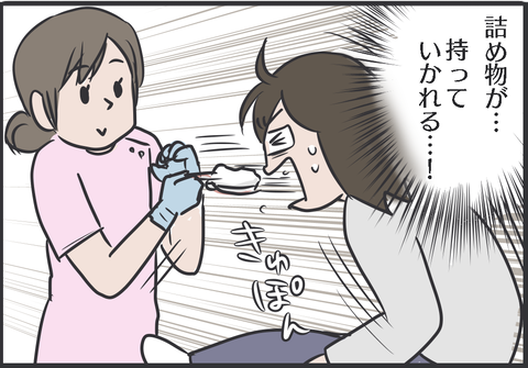 歯型取り