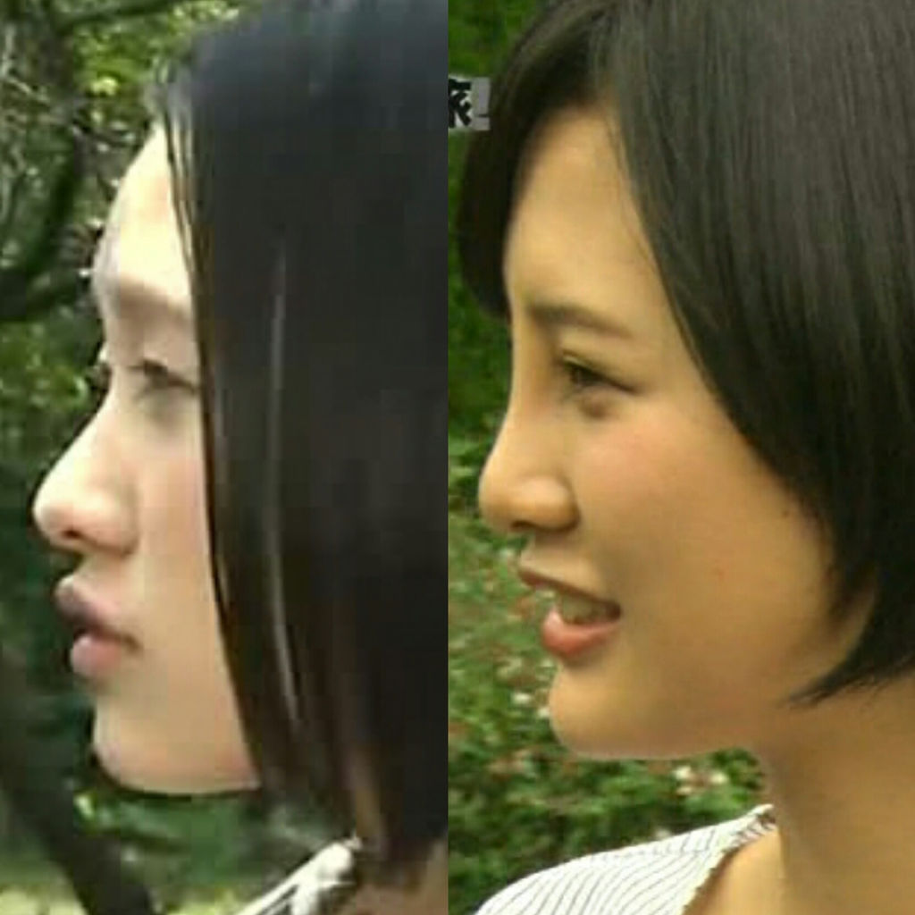 小嶋陽菜の鼻が大変なことになってる まとめネタ