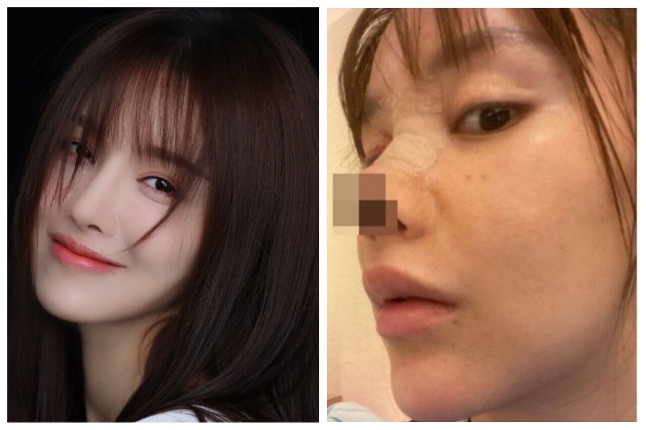 閲覧注意 整形失敗 中国女優の高溜 ガオ リュウ さん 鼻整形後に 壊死 話のネタ帳 閲覧注意 整形失敗 中国女優の高溜 ガオ リュウ さん 鼻整形後に 壊死 話のネタ帳