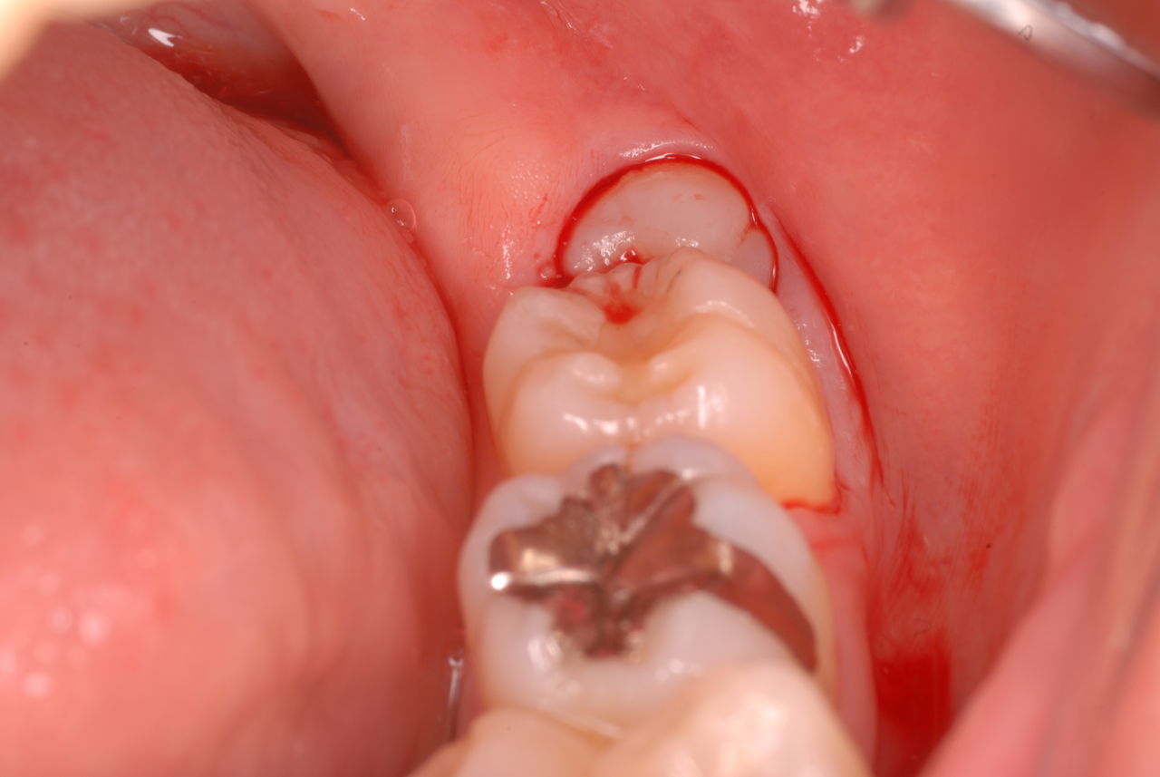 止まら 血 ない 後 が 抜歯 歯を抜いた後の注意点（抜歯後の注意点）