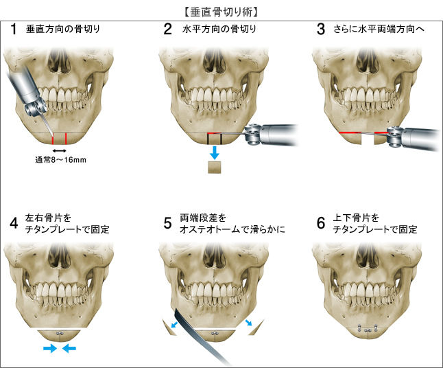 韓国人女子大生 両エラを切除後に死亡 Mabuchanのblog