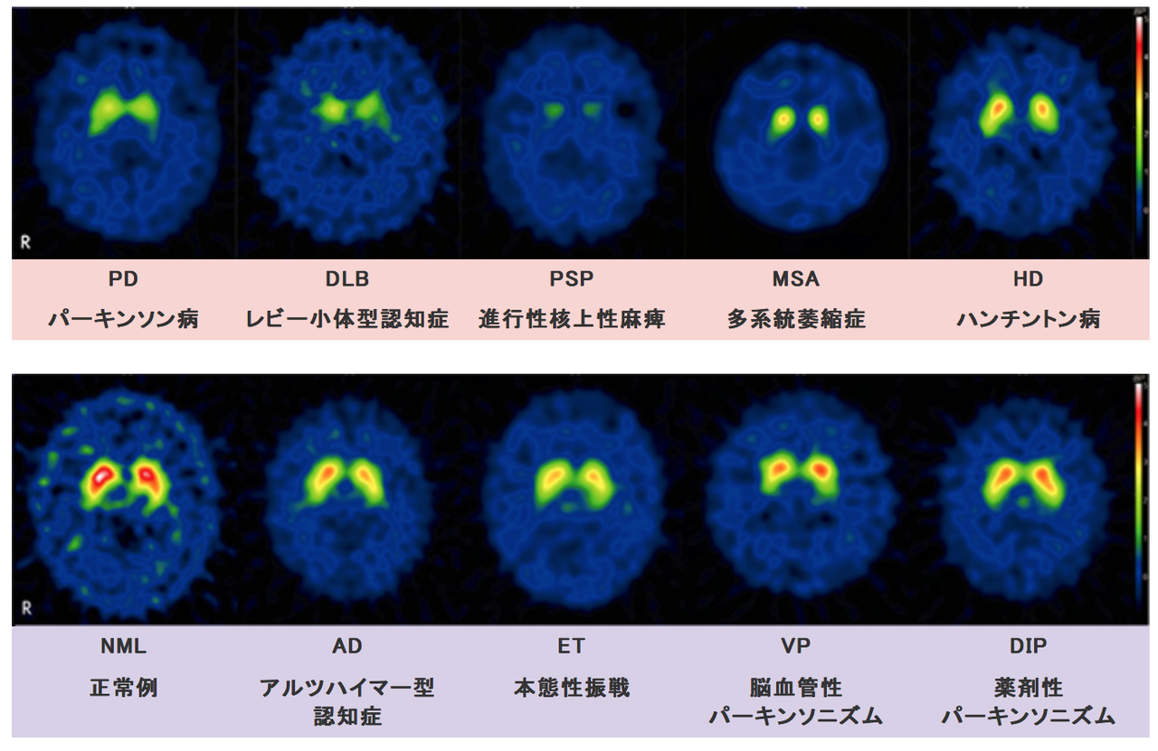 レビー小体型認知症の検査 世界一わかりやすい医学 人工知能時代における医学情報の再定義