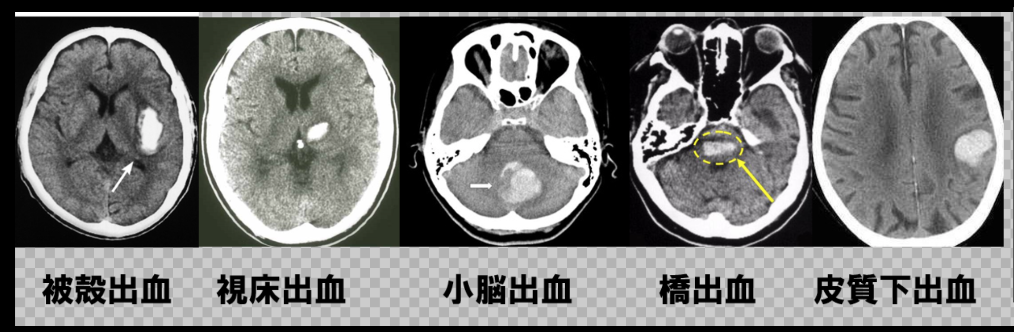 くも膜下出血 Ct Mri メディカルアドバイス|健康のために|広報・読み物|武田 Anterior and posterior muscular compartment くも膜下出血 Ct Mri メディカルアドバイス|健康のために|広報・読み物|武田 Anterior and posterior muscular compartment