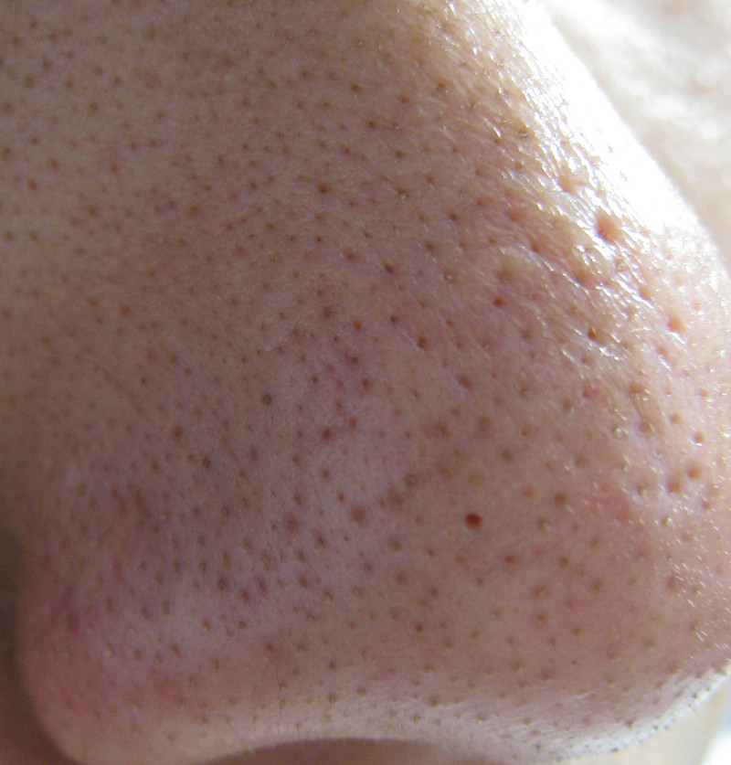 ﾌﾞﾂﾌﾞﾂで鼻がイチゴみたいなってる そんでそのﾌﾞﾂﾌﾞﾂにエイリアンの卵みたいなのがﾋﾞｯｼﾘ生えてる 微グロ注意 ニュー粕速報ゆとり