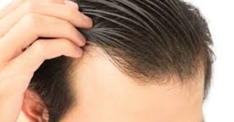 【悲報】ハゲ治療のトラブルが急増、4年間で3倍になってしまう