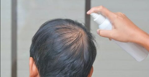 【悲報】20代の3人に1人がハゲ対策のスプレーを使っている事が判明