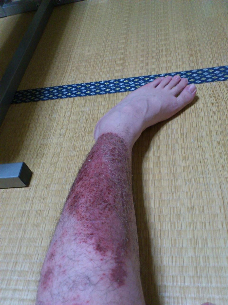 グロ注意 アトピーがうぜぇから発狂して皮膚抉ったらゾンビみたいになった ゴリラ速報 グロ注意 アトピーがうぜぇから発狂して皮膚抉ったらゾンビみたいになった ゴリラ速報
