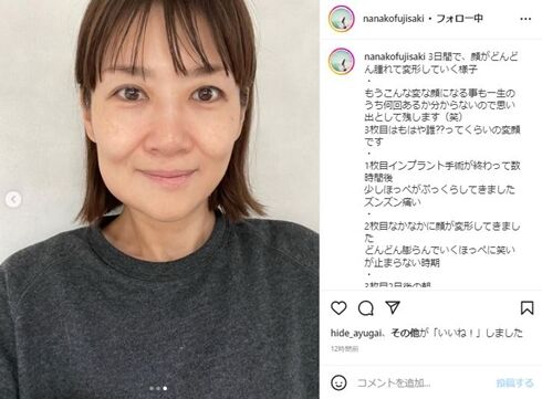 藤崎奈々子　インプラント手術で「顔がどんどん腫れて変形」と報告
