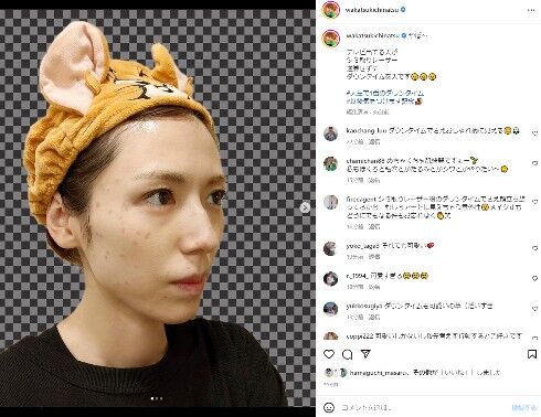 【芸能】若槻千夏、シミ取りレーザーのダウンタイム中の姿を公開