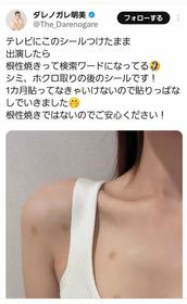 【芸能】ダレノガレ明美（33）視聴者指摘の〝胸元の斑点〟を釈明