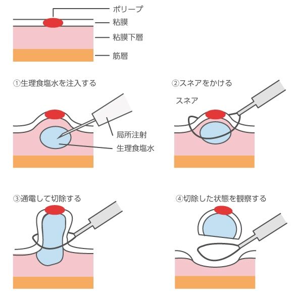 若い世代のための大腸がん予防ガイド：最新の検診と治療法