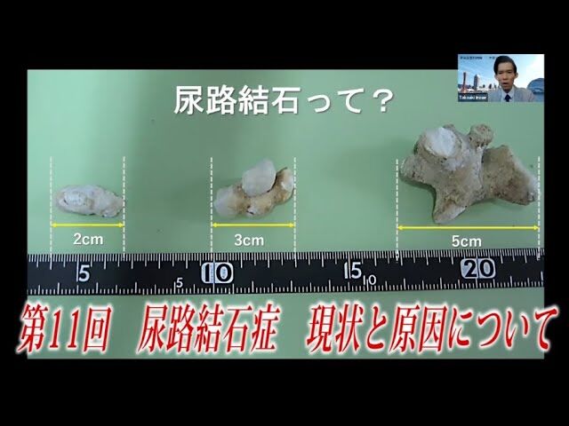 『尿路結石...原因＆予防法』について : ニュースまとめちゃんねる早分かり速報