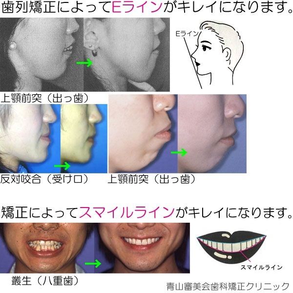 コンプレックス速報 アゴ 顎がない 後退している人その5 あご