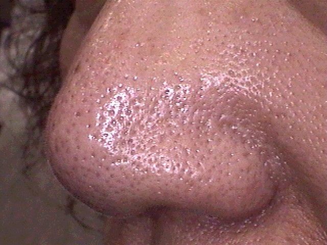 コンプレックス速報 鼻 いちご鼻 32穴目 毛穴