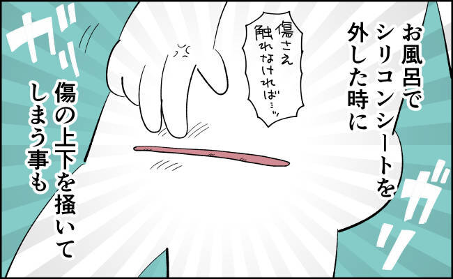 んぎぃちゃん産後秘話49 帝王切開の傷の痒み スーパープロ幼児んぎぃちゃん Powered By ライブドアブログ