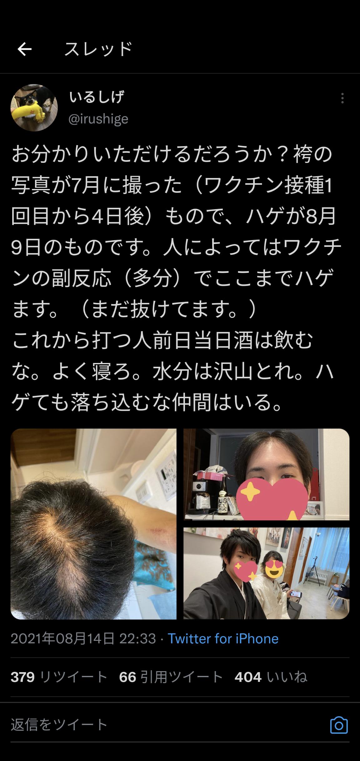 画像 ワクチンを打った後抜け毛が増えたと訴える人物がツイッターで経過を報告 ちょっとこれは なお関連性は不明 ろいアンテナ