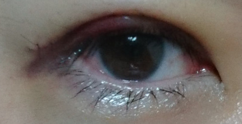 眼科医が二重まぶたの手術 切開法 を受けることになったブログ