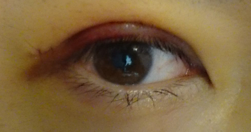 眼科医が二重まぶたの手術 切開法 を受けることになったブログ