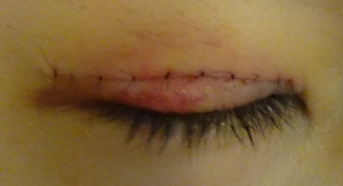 眼科医が二重まぶたの手術 切開法 を受けることになったブログ