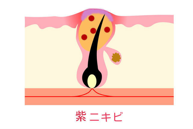 紫ニキビ ニキビ解決