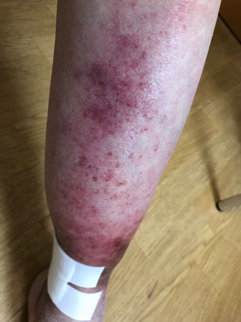 炎 は 織 蜂窩 と