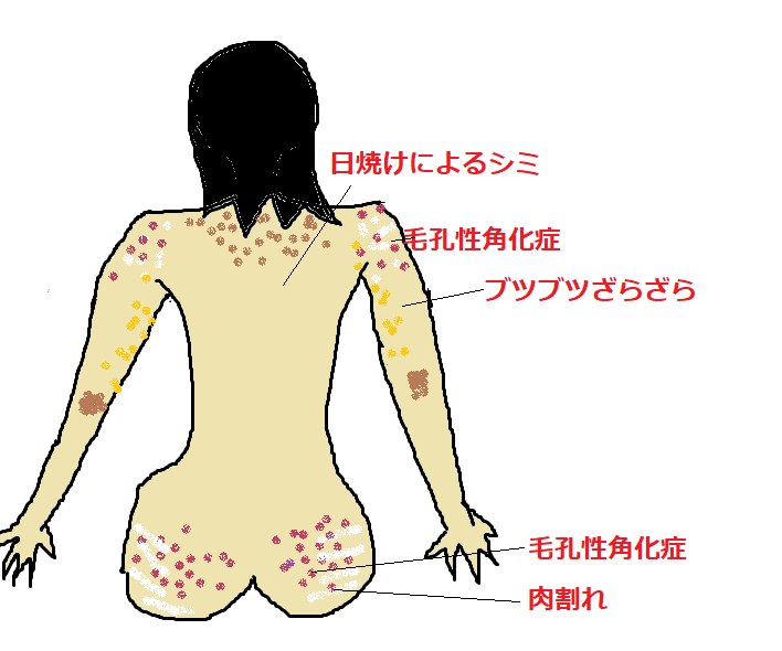 18年08月 肉割サメ肌子のザラ肌格闘blog 18年08月 肉割サメ肌子のザラ肌格闘blog