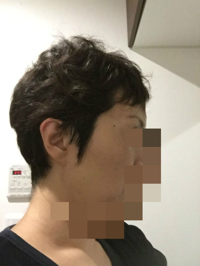 抗がん剤最終投与から8ヵ月目の発毛状況 Lasting Blue