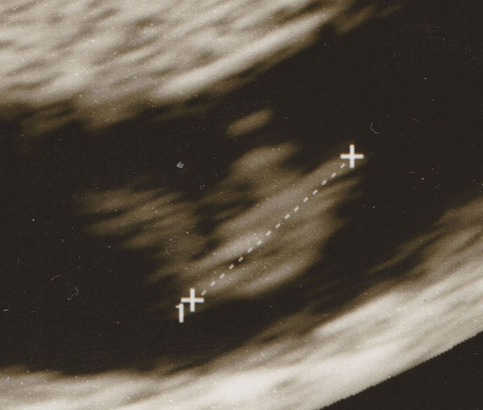 流産宣告 妊婦ニューヨーカーのお散歩日記