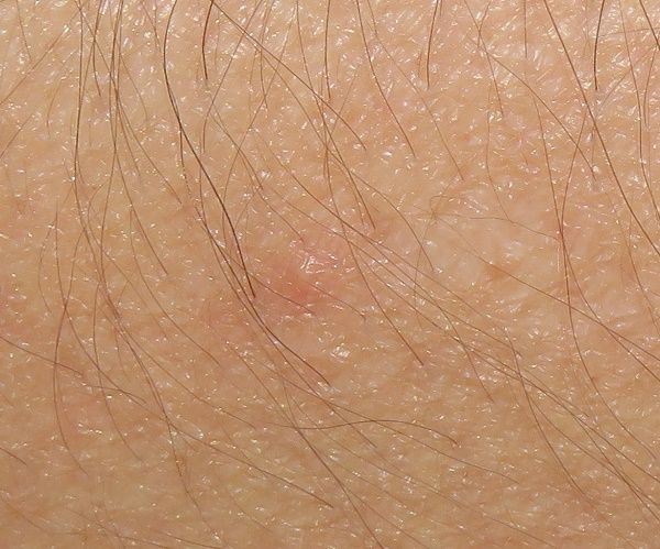 残暑により、癤（せつ）、粉瘤の化膿、肛門周囲膿瘍が増加しています。痒み防止剤（栴檀海斗）が予防になります。 : 特許技術で病気にならない医学を ...