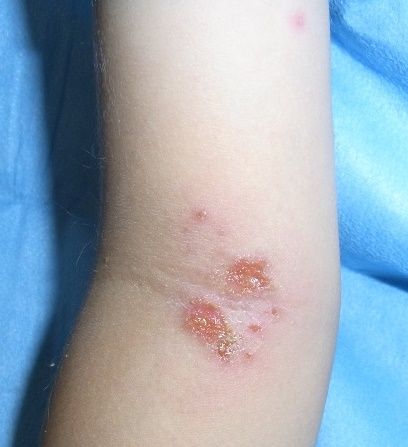 とびひ 伝染性膿痂疹 が増加しています 特許技術で病気にならない医学を提案する にっしん皮フ科 形成外科 最新情報 とびひ 伝染性膿痂疹 が増加しています 特許技術で病気にならない医学を提案する にっしん皮フ科 形成外科 最新情報