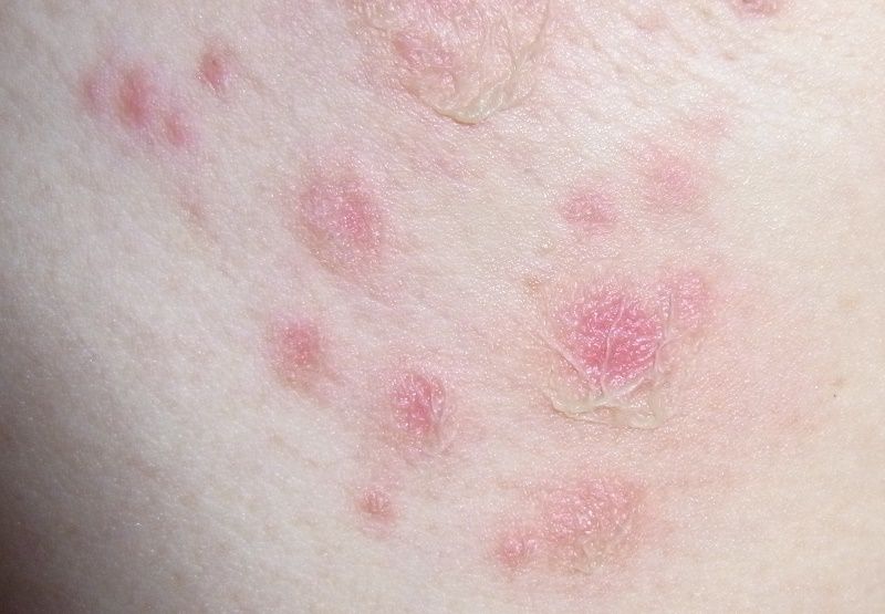とびひ 伝染性膿痂疹 が増加しています 特許技術で病気にならない医学を提案する にっしん皮フ科 形成外科 最新情報 とびひ 伝染性膿痂疹 が増加しています 特許技術で病気にならない医学を提案する にっしん皮フ科 形成外科 最新情報